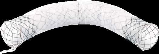 Taewoong Niti-S BUMPY covered biliary stent with segmented middle band