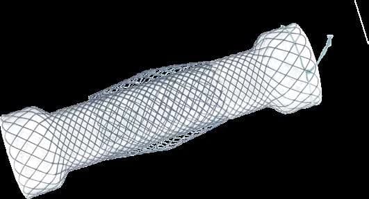 Taewoong Niti-S DOUBLE esophageal stent with double-layer covered body and flared ends