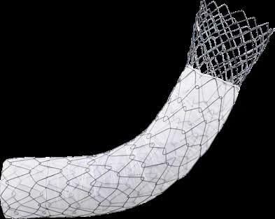 Taewoong Niti-S COMVI pyloric/duodenal stent with uncovered proximal flare end, curved body