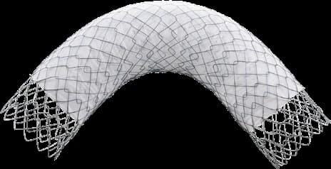 Taewoong Niti-S COMVI pyloric/duodenal stent, triple-layered covered mesh arched
