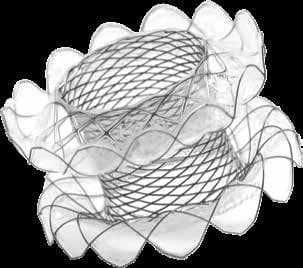 Taewoong Niti-S SPAXUS lumen-apposing metal stent with petal-shaped flanges